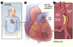 冠心病的起因是什么？
