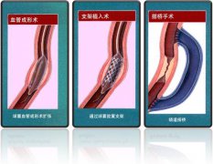 怎樣治療冠心??？