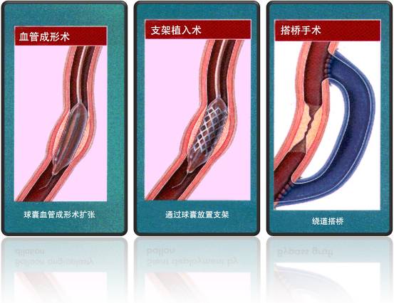 怎樣治療冠心?。?圖1)